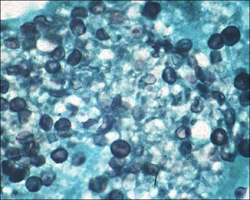 Pneumocystis carinii