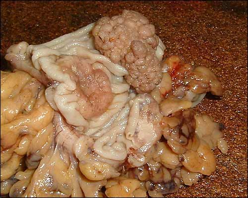 Carcinom und Adenom im Dickdarm