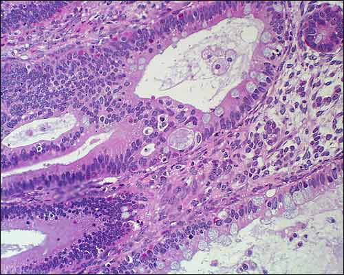 Colonmucosa mit Atypien