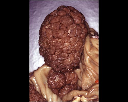 Dickdarmadenome