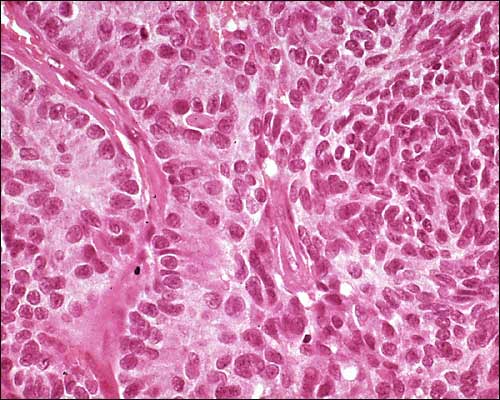 Medull&auml;res Schilddr&uuml;sen-Carcinom